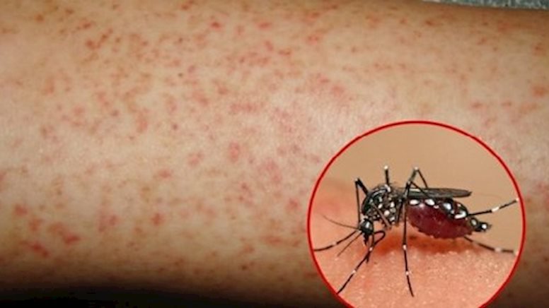 Sốt xuất huyết có lây không?