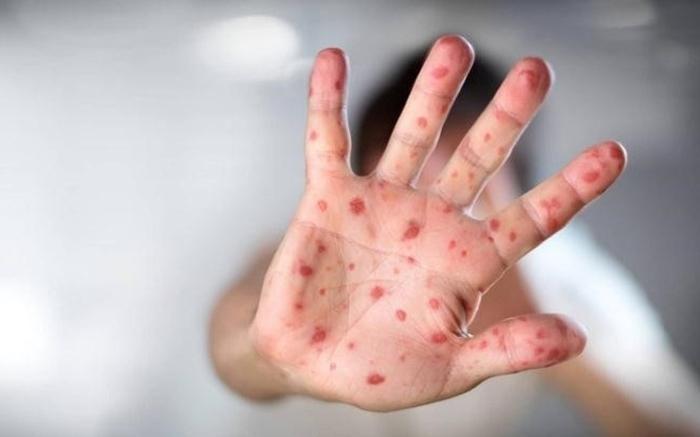 Chăm sóc trẻ bị tay chân miệng tại nhà: 5 việc quan trọng cần làm