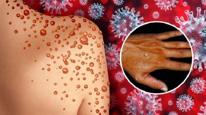 6 khuyến cáo phòng chống bệnh đậu mùa khỉ